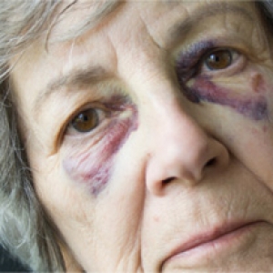 Elder abuse - black eyes